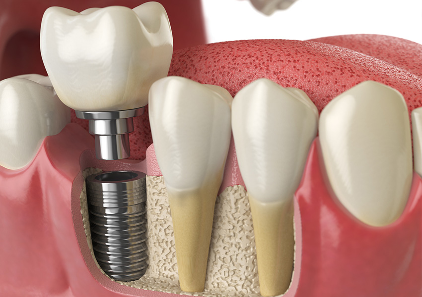 İmplant Tedavisi